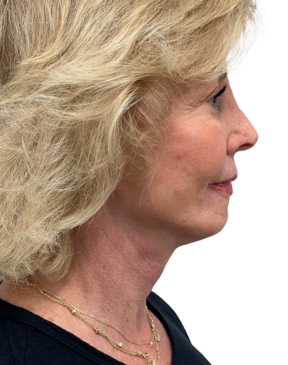 Facelift / Neck Lift