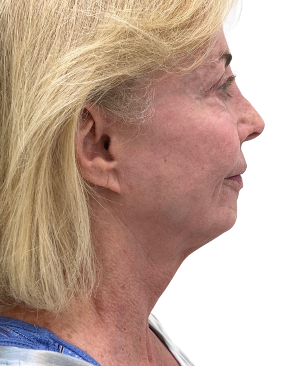 Facelift / Neck Lift