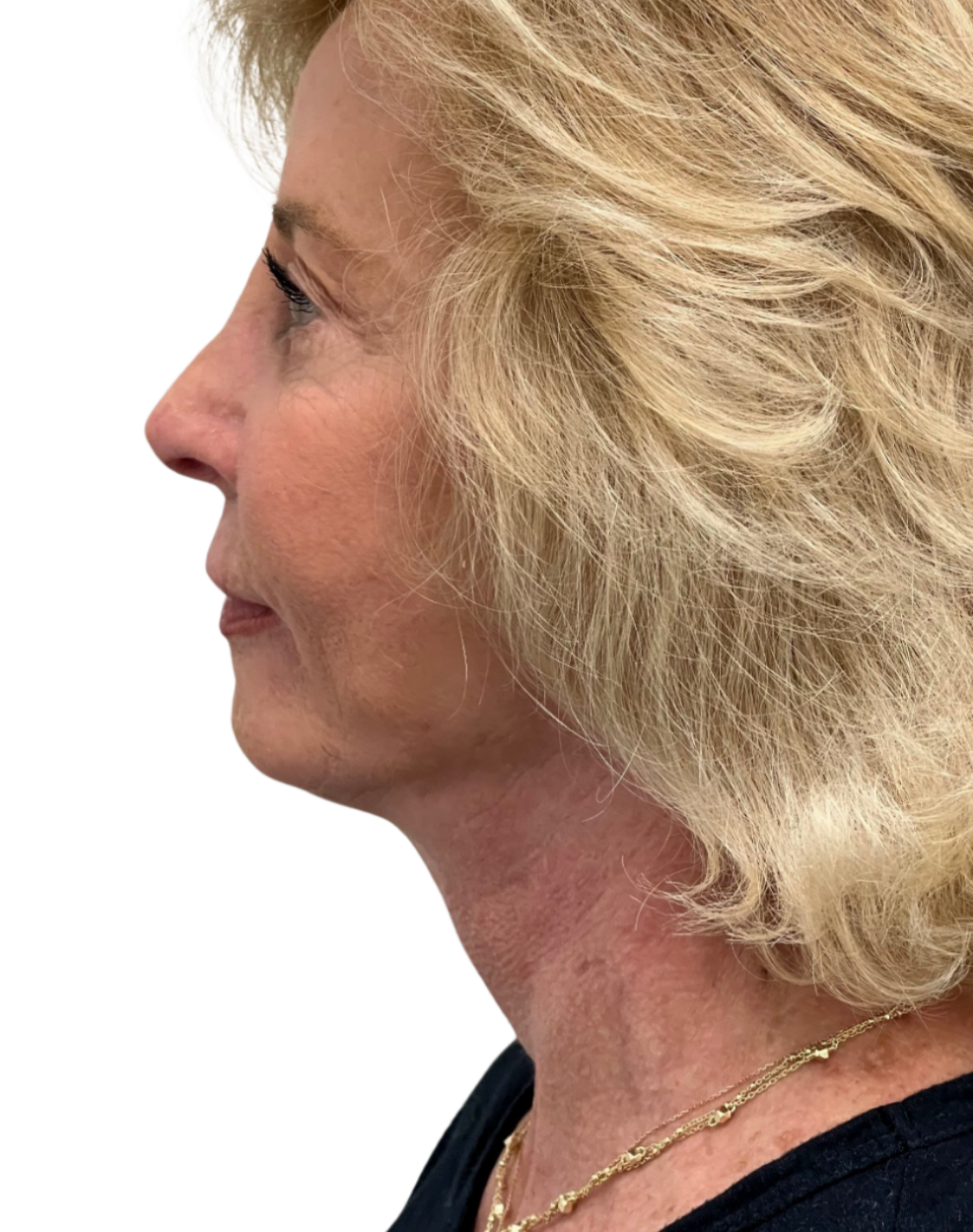 Facelift / Neck Lift