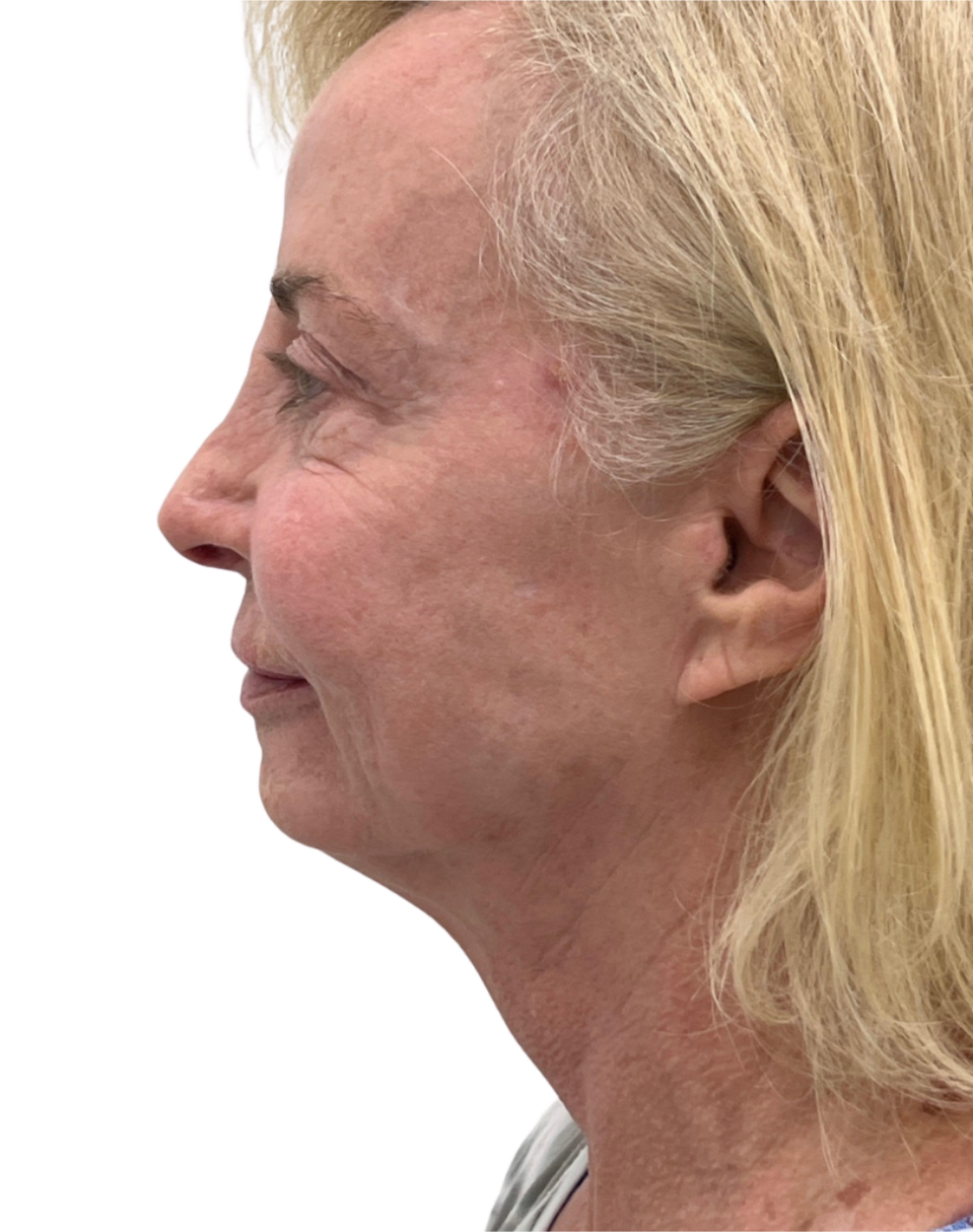 Facelift / Neck Lift