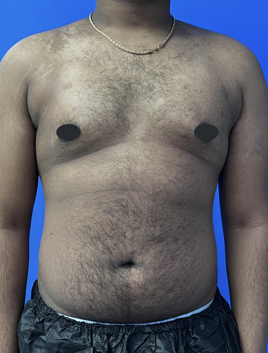 Gynecomastia