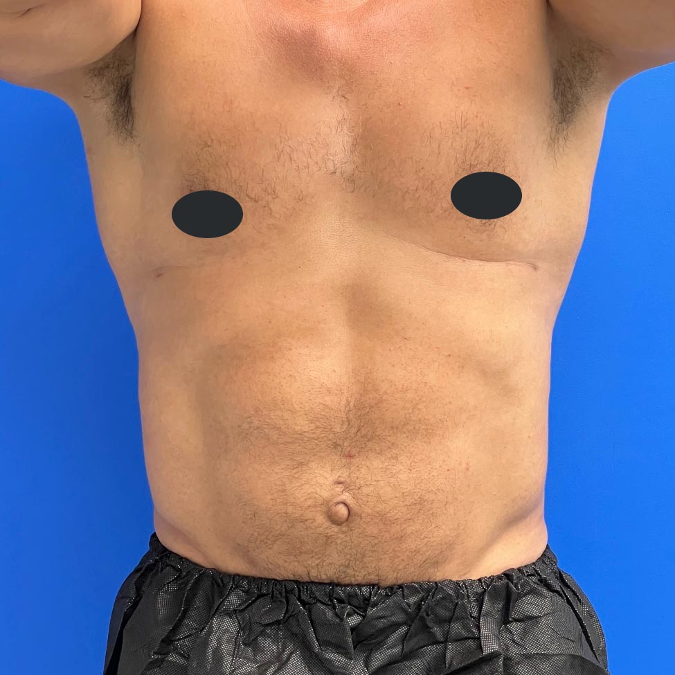 Gynecomastia