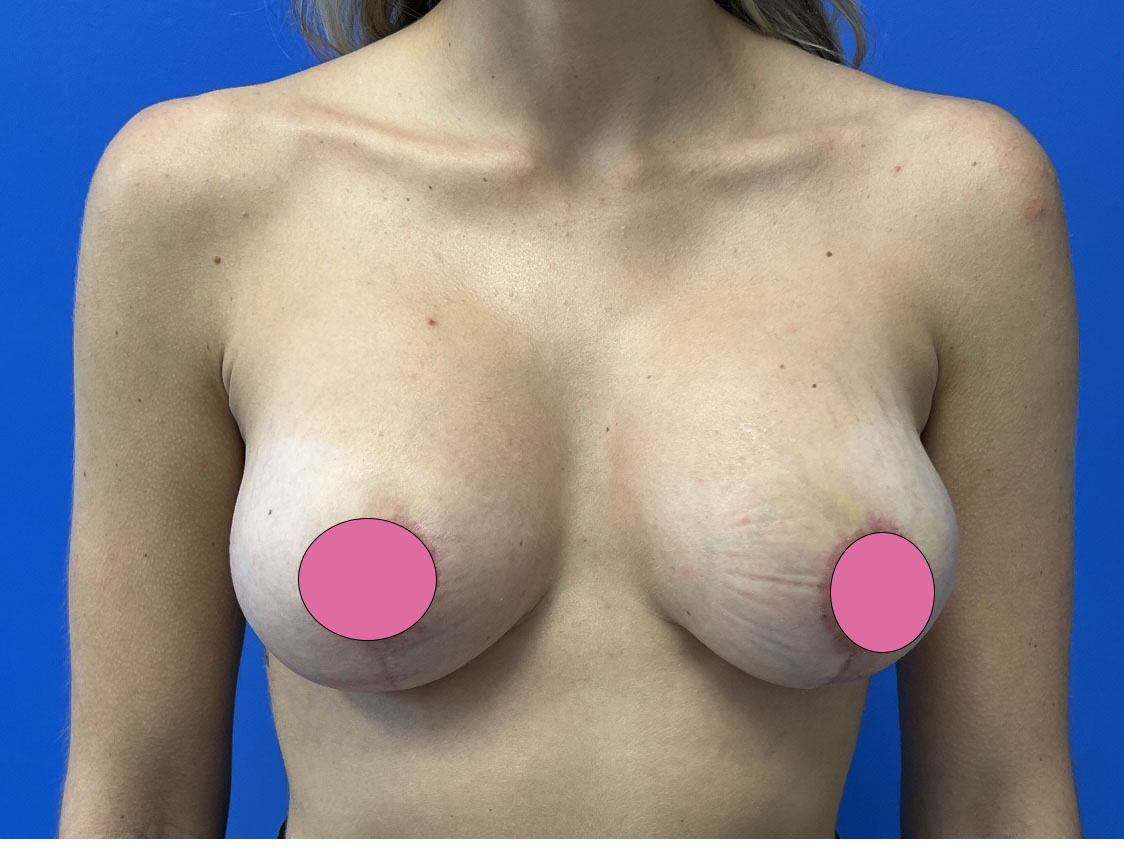 Breast Augmentation with Lift