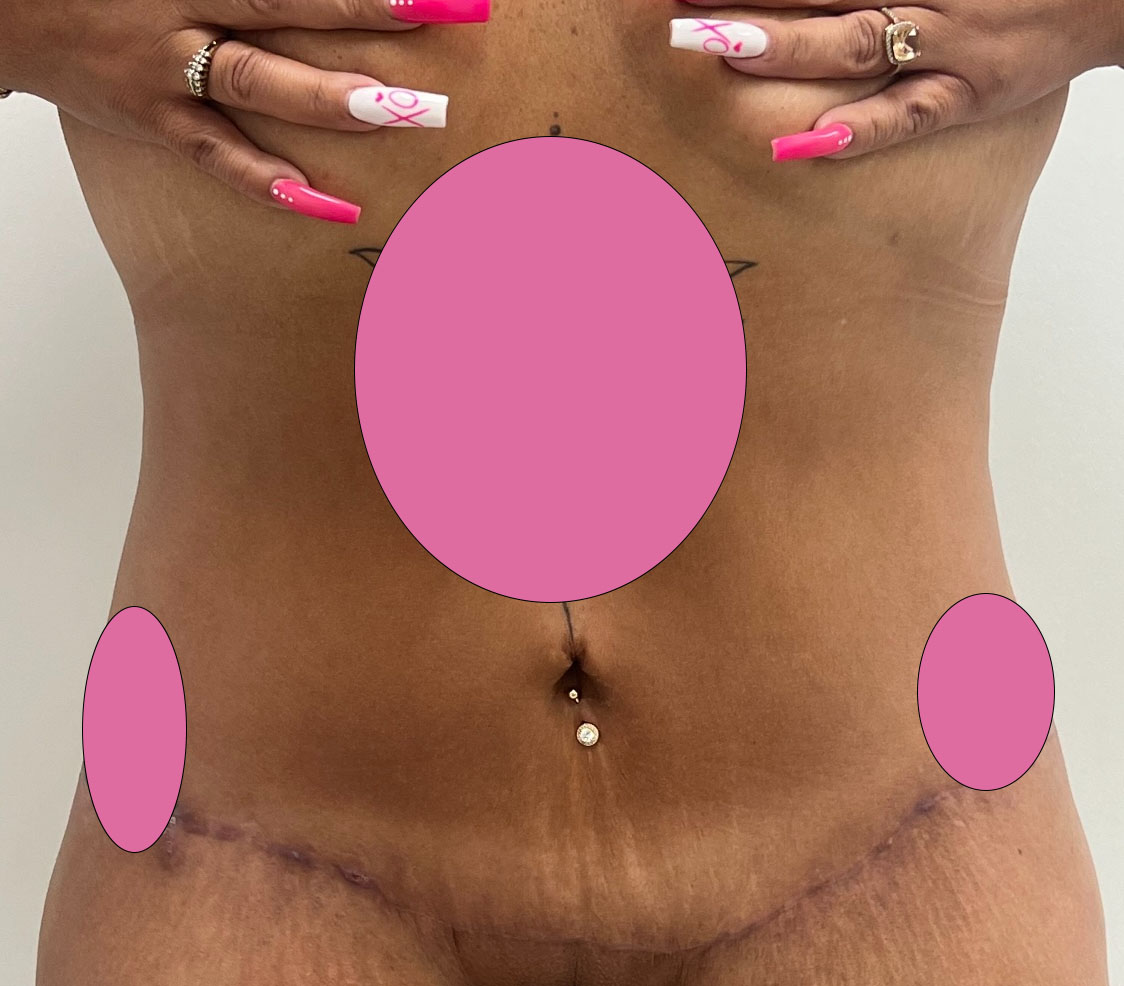 Tummy Tuck