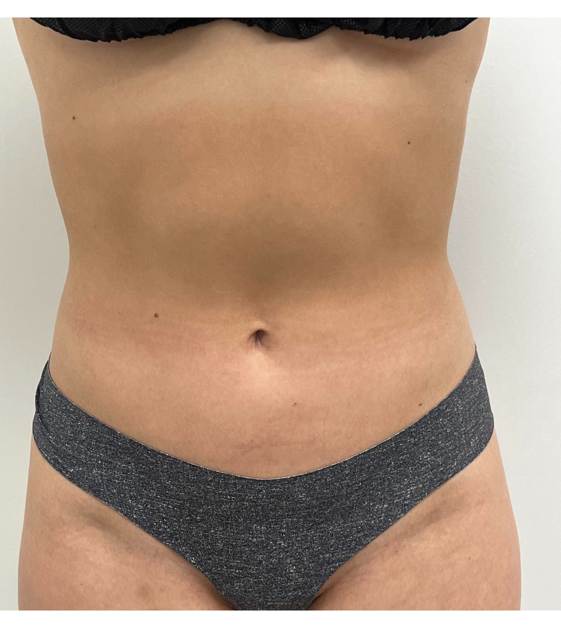 Liposuction