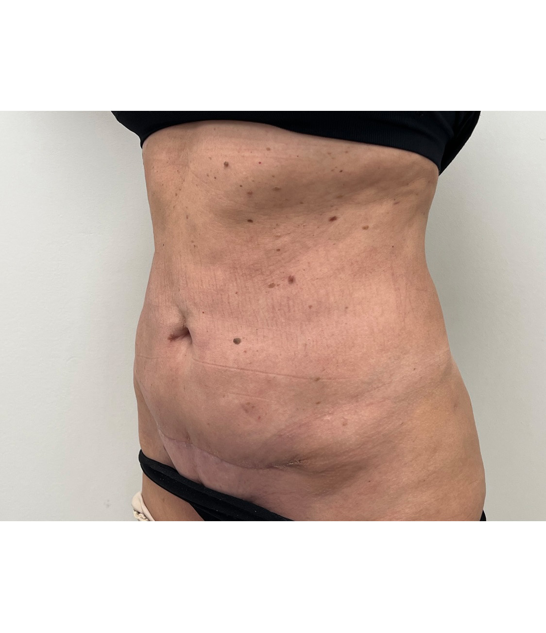 Tummy Tuck