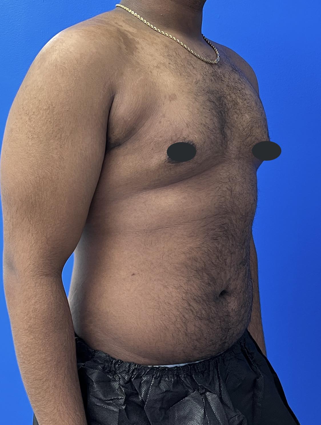 Gynecomastia