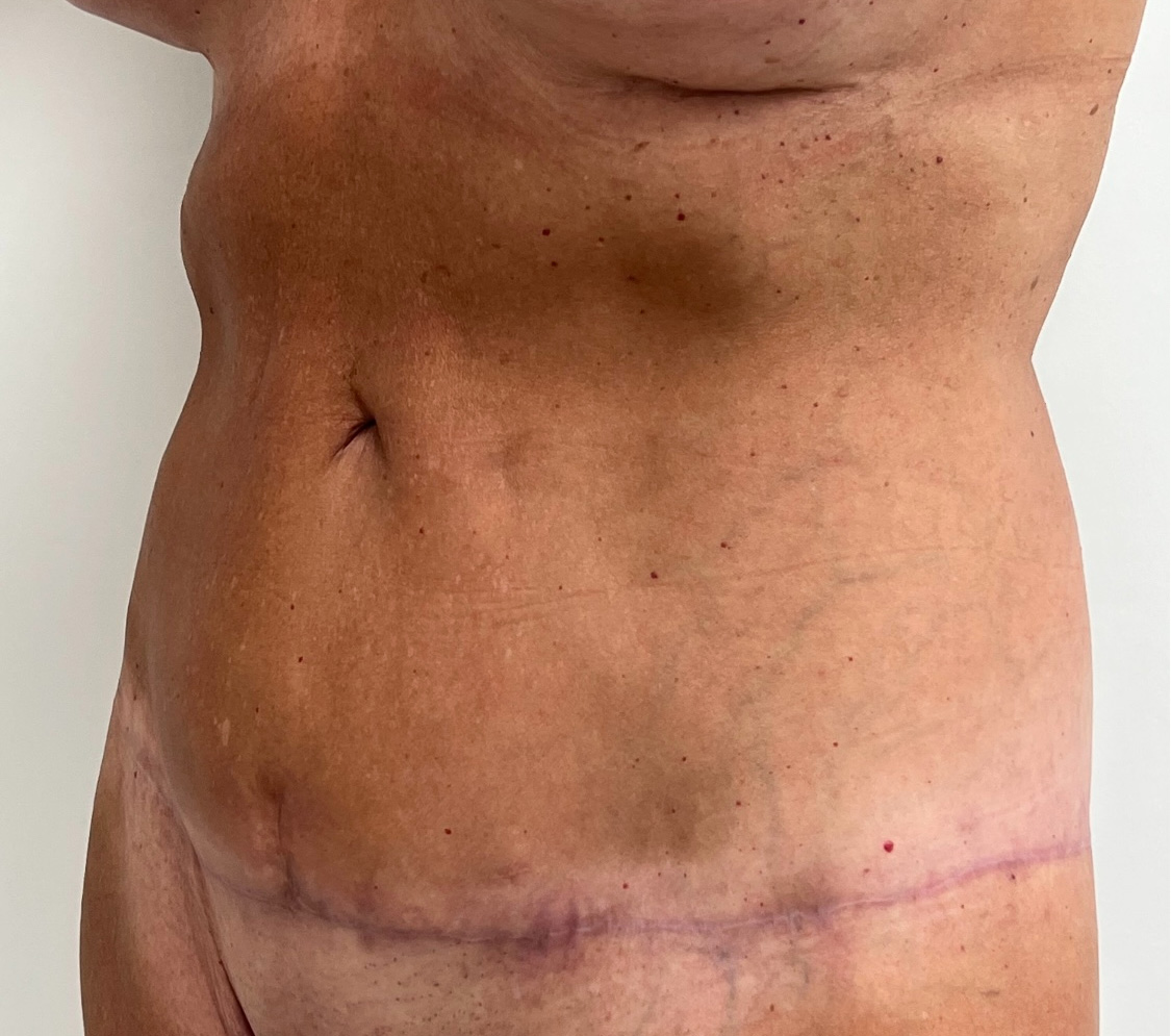 Tummy Tuck