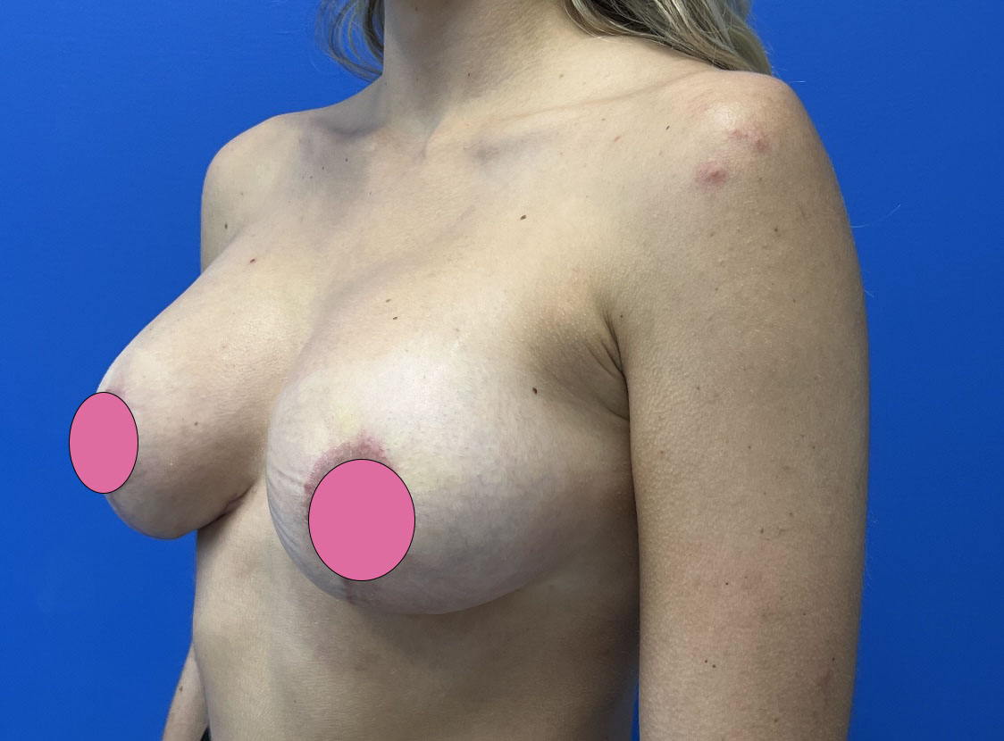 Breast Augmentation with Lift