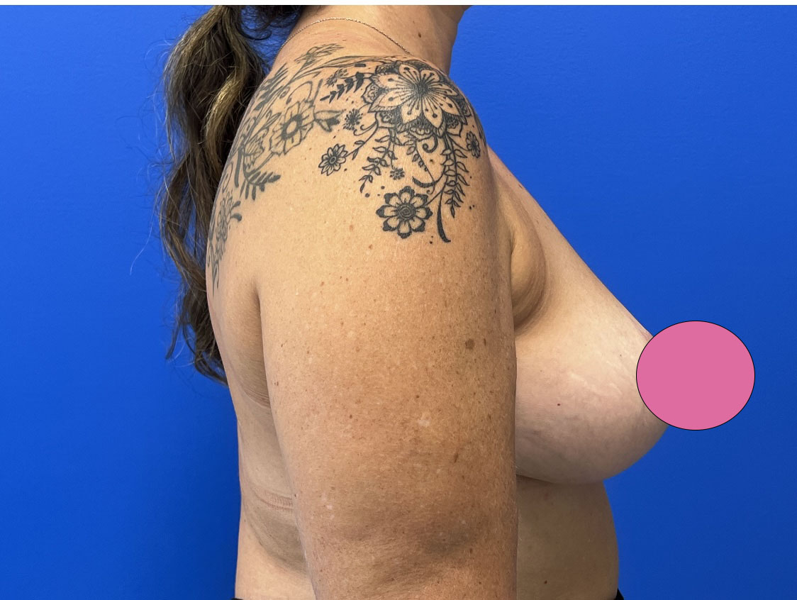 Breast Augmentation with Lift