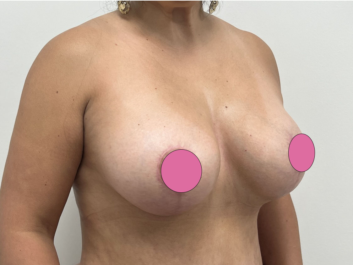 Breast Implant Revision