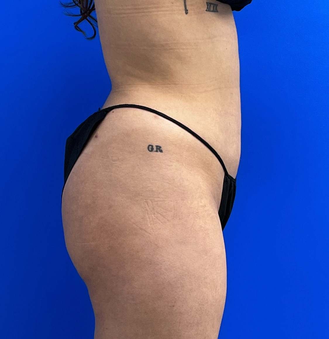 Brazilian Butt Lift Before & After