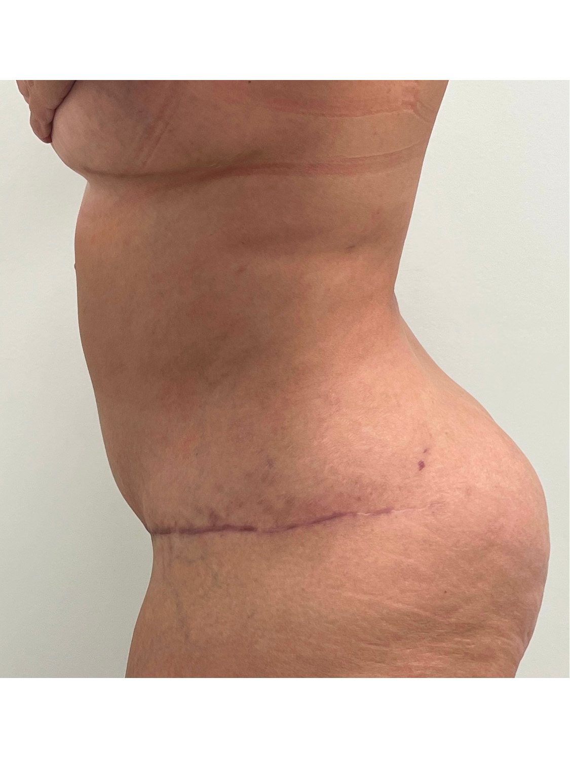 Tummy Tuck