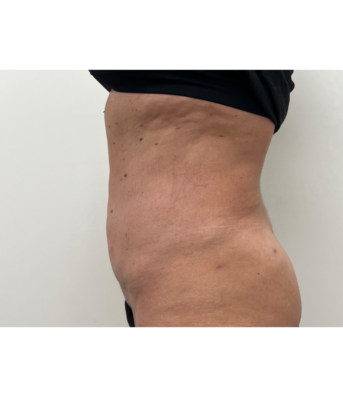 Tummy Tuck