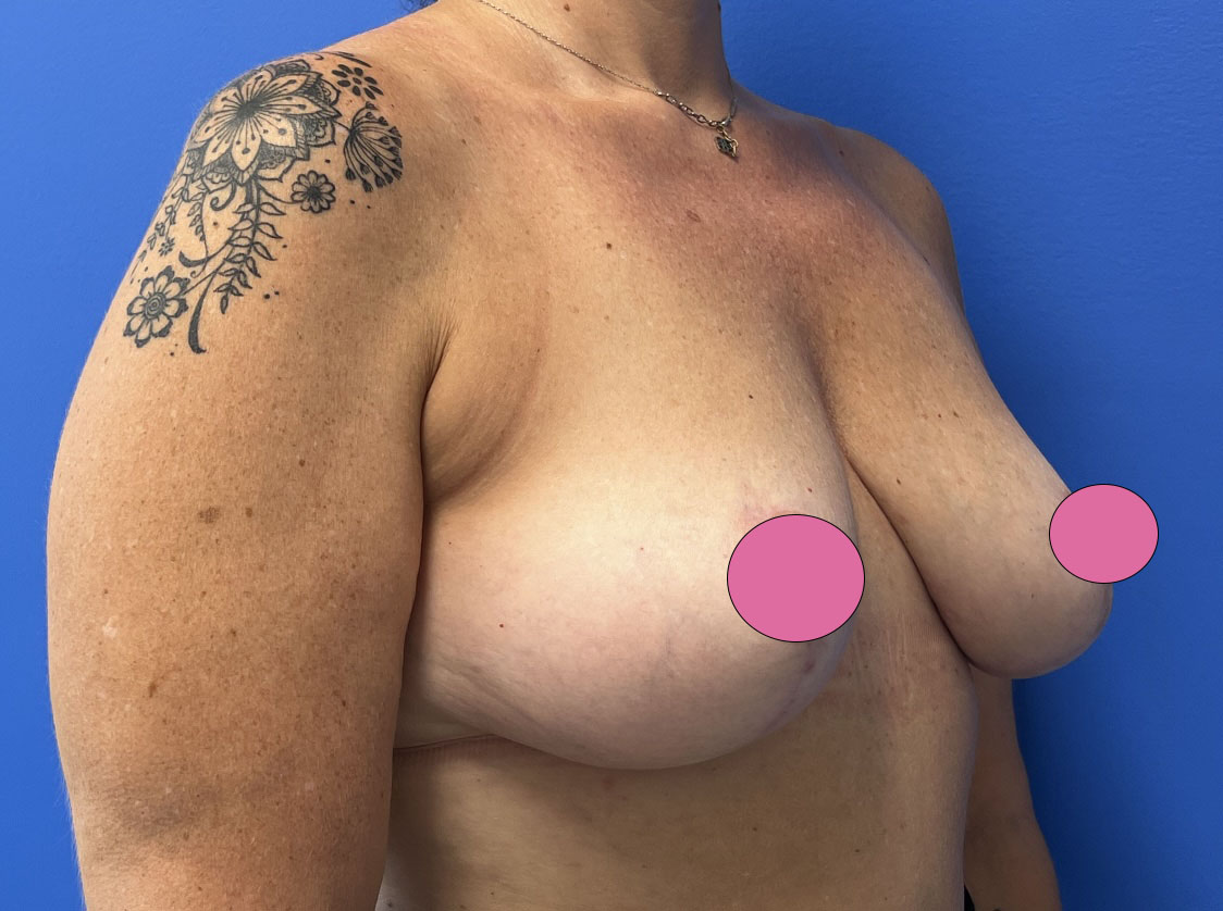 Breast Augmentation with Lift