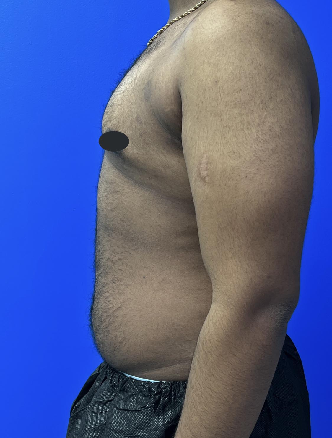 Gynecomastia