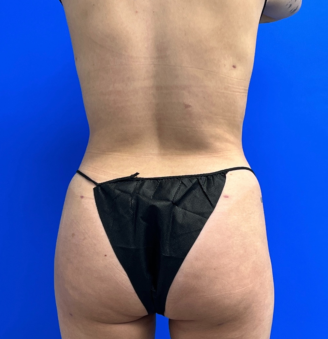 Brazilian Butt Lift Before & After
