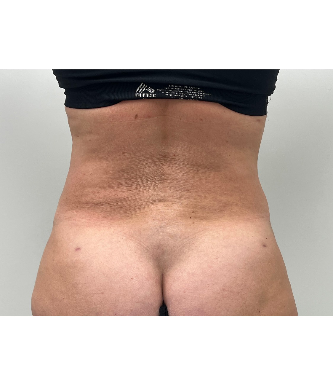 Tummy Tuck