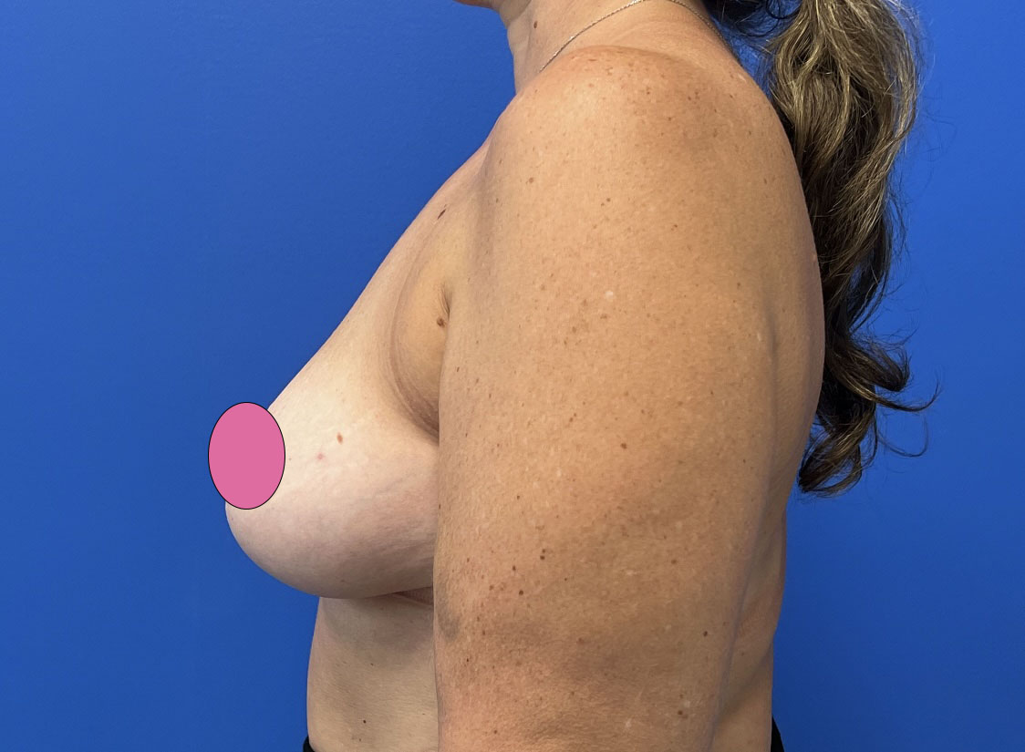 Breast Augmentation with Lift