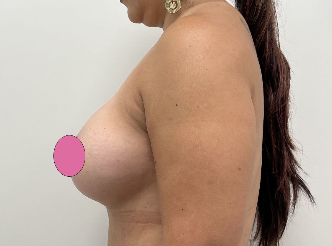 Breast Implant Revision