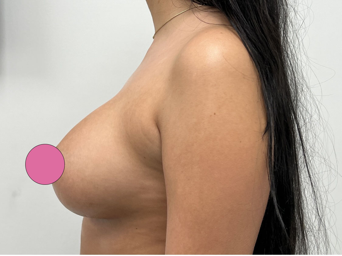 Breast Augmentation Before & After