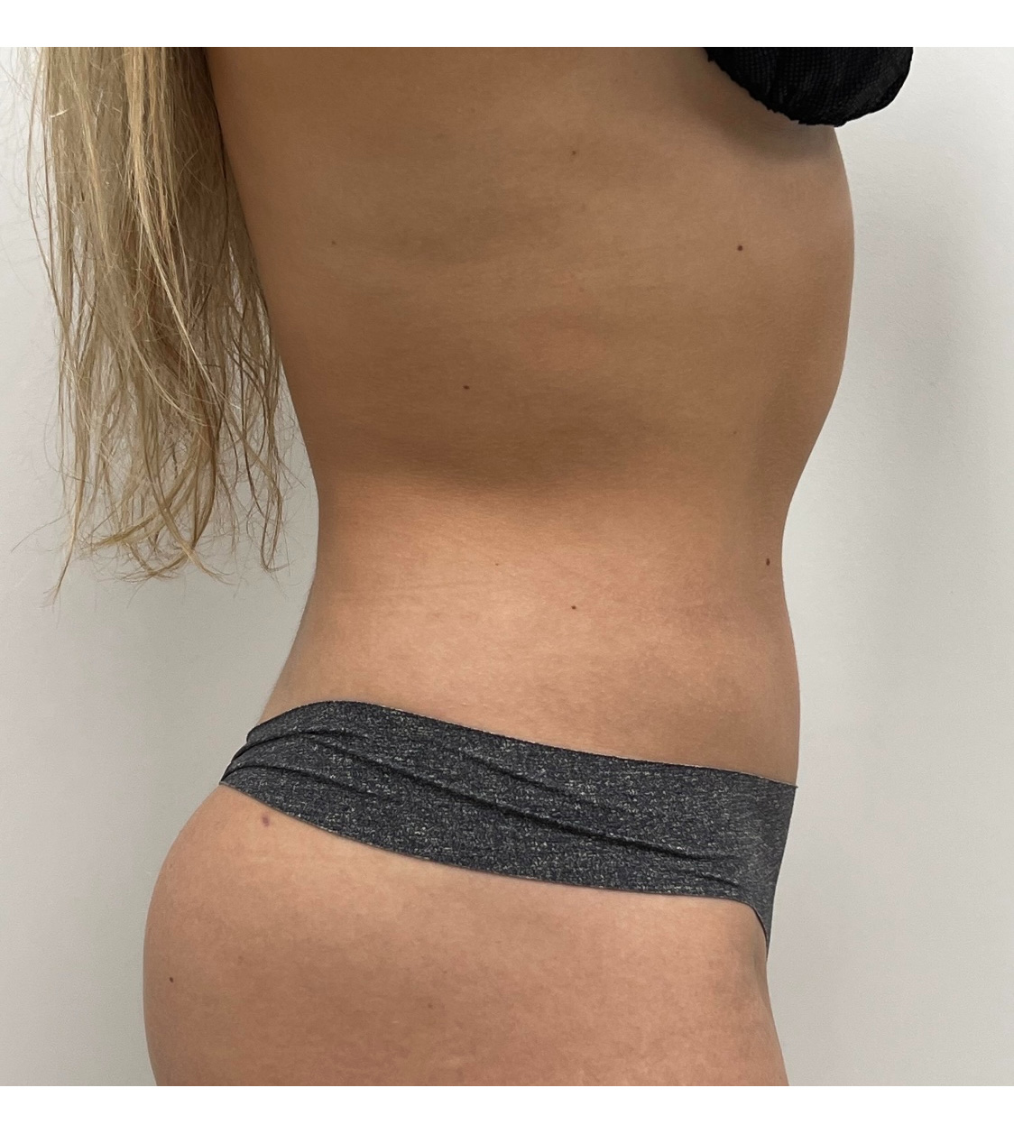 Liposuction