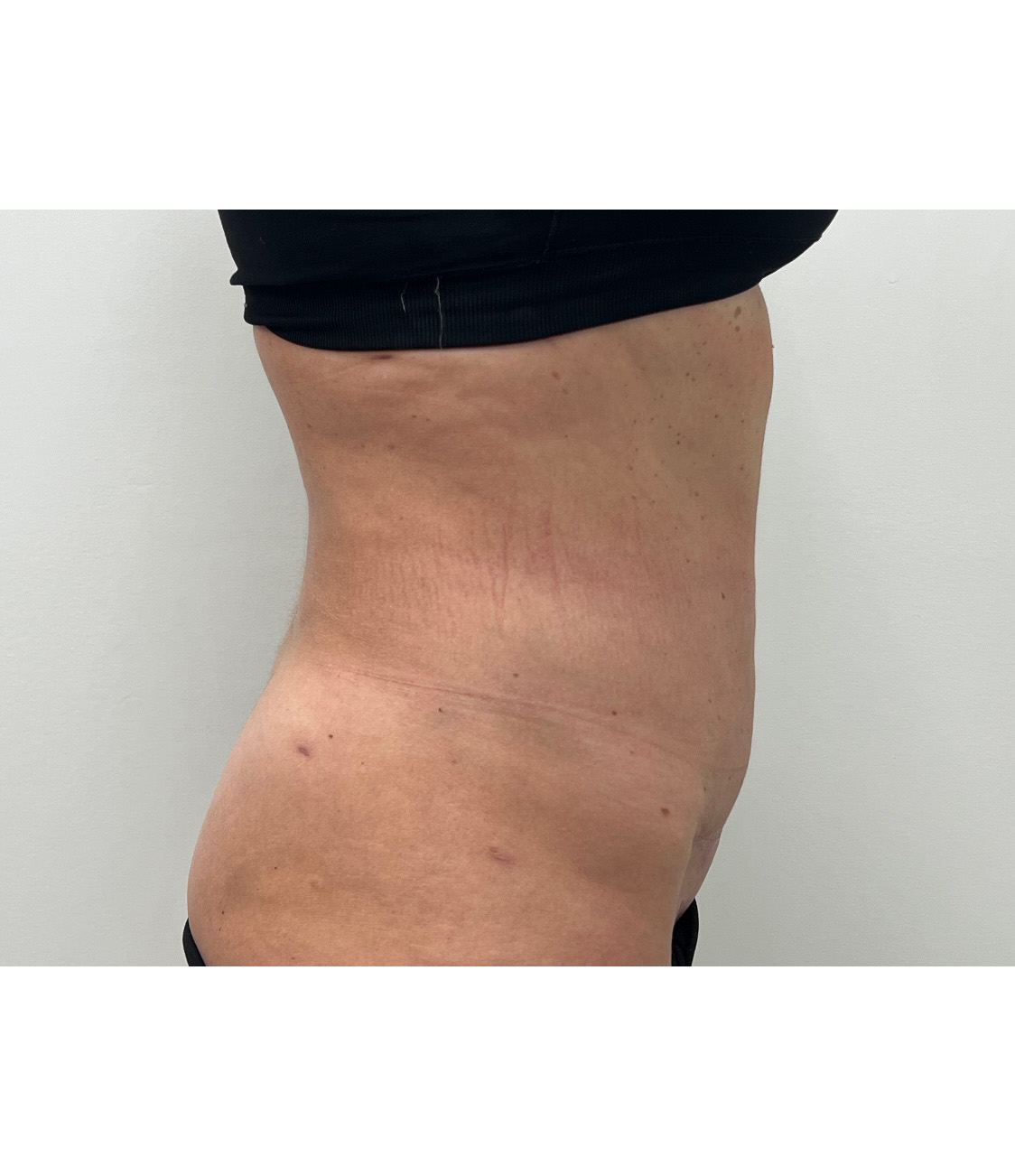 Tummy Tuck