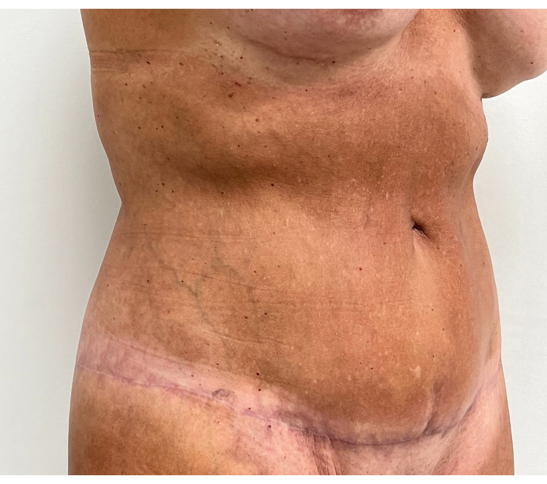 Tummy Tuck