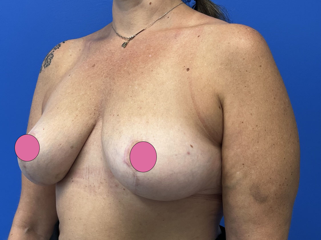 Breast Augmentation with Lift