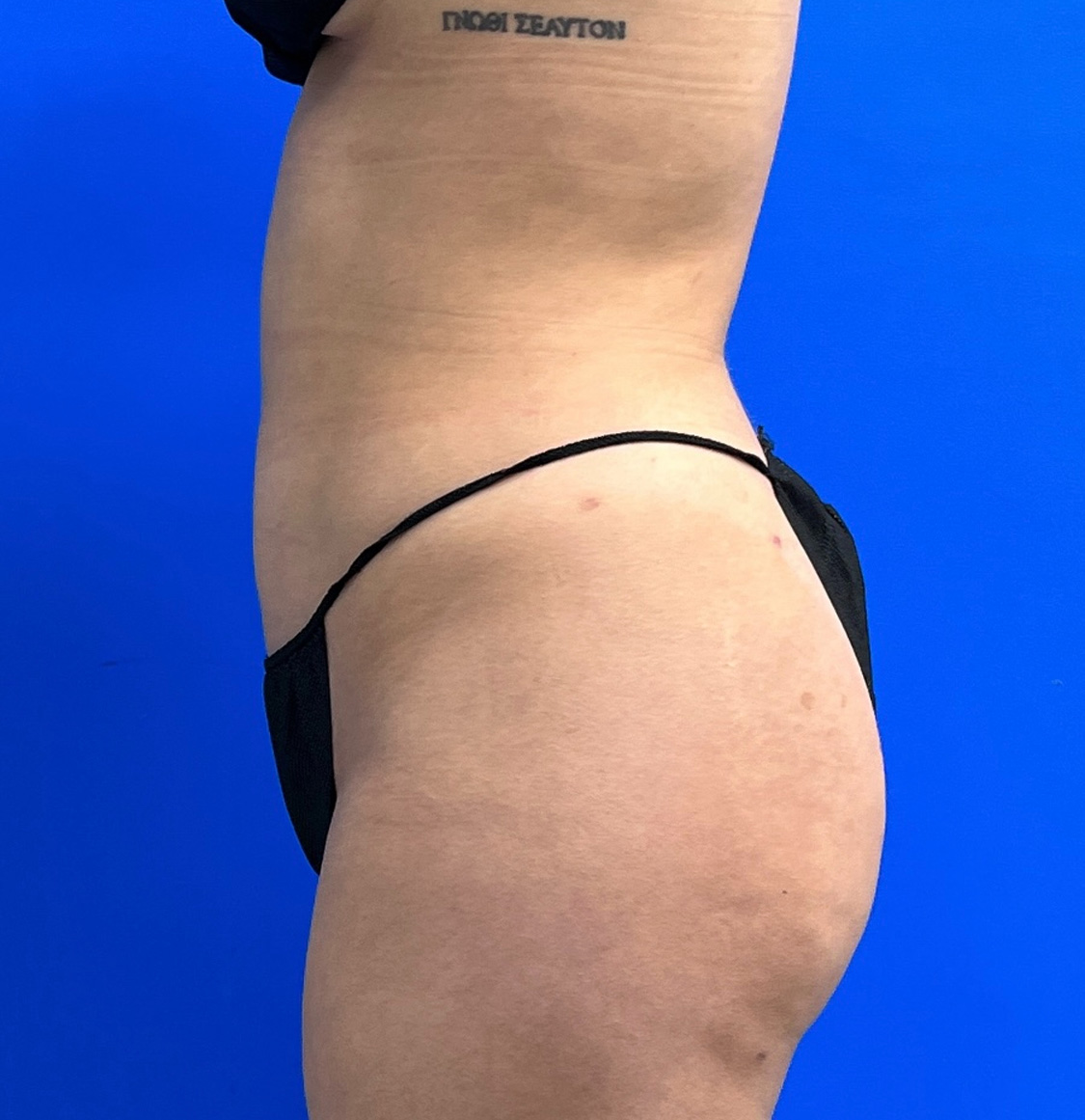 Brazilian Butt Lift Before & After