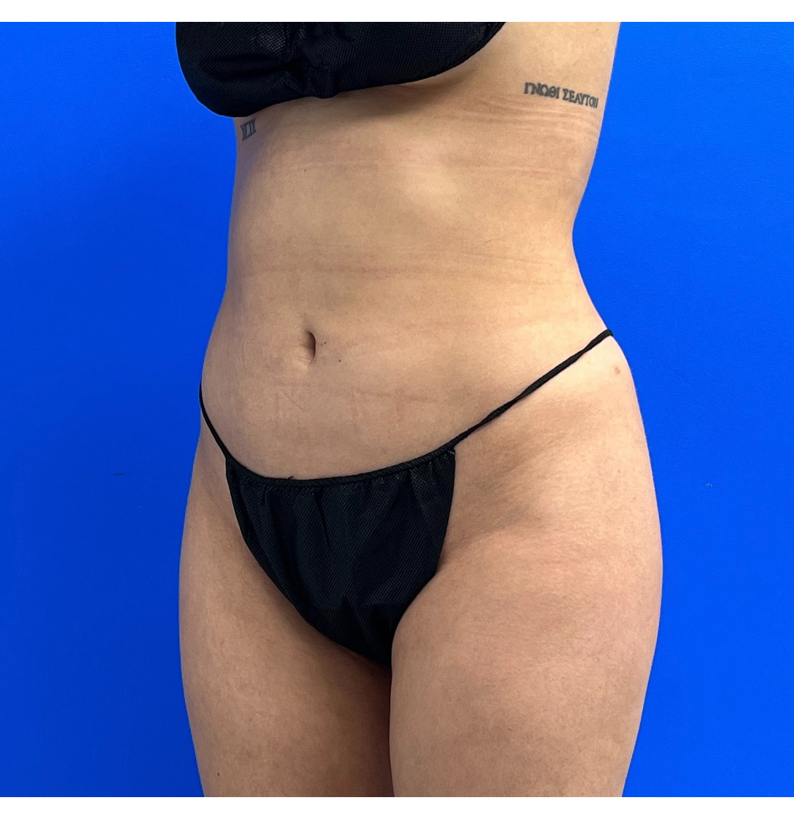 Brazilian Butt Lift Before & After