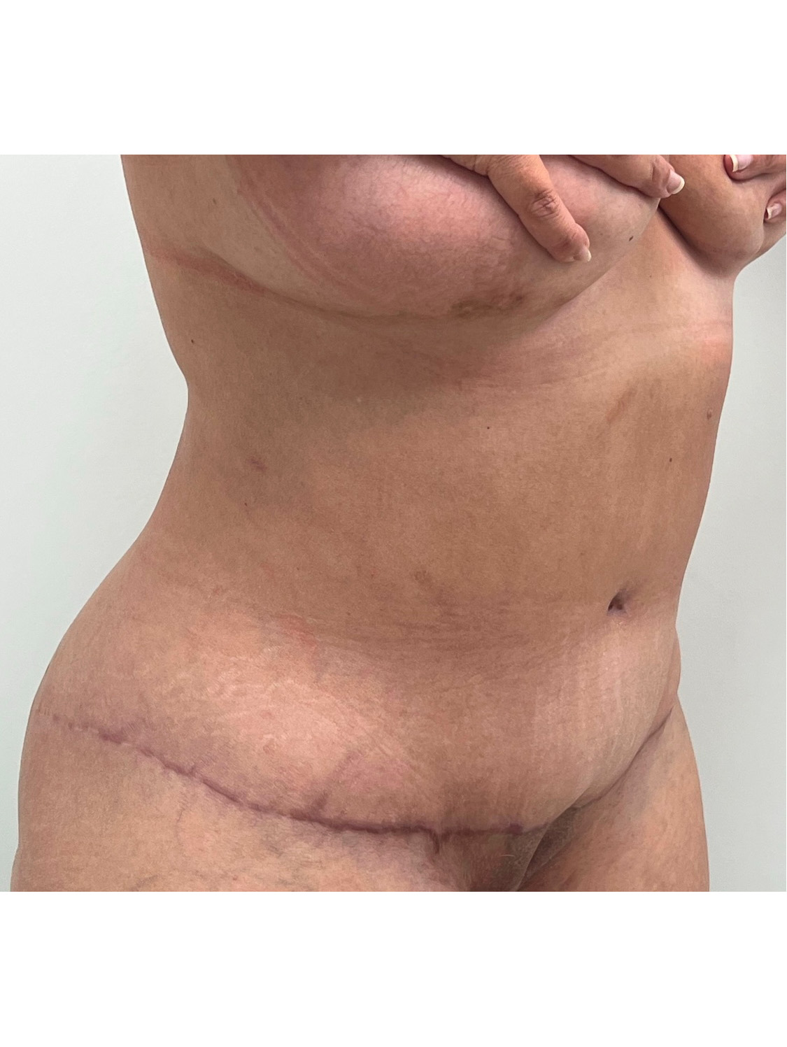 Tummy Tuck