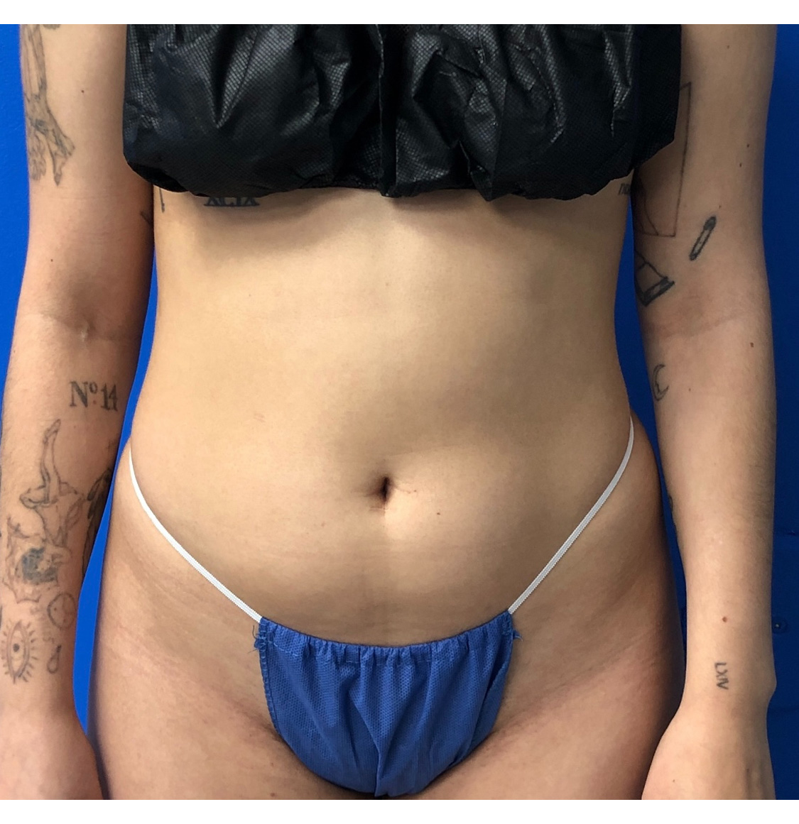 Brazilian Butt Lift Before & After