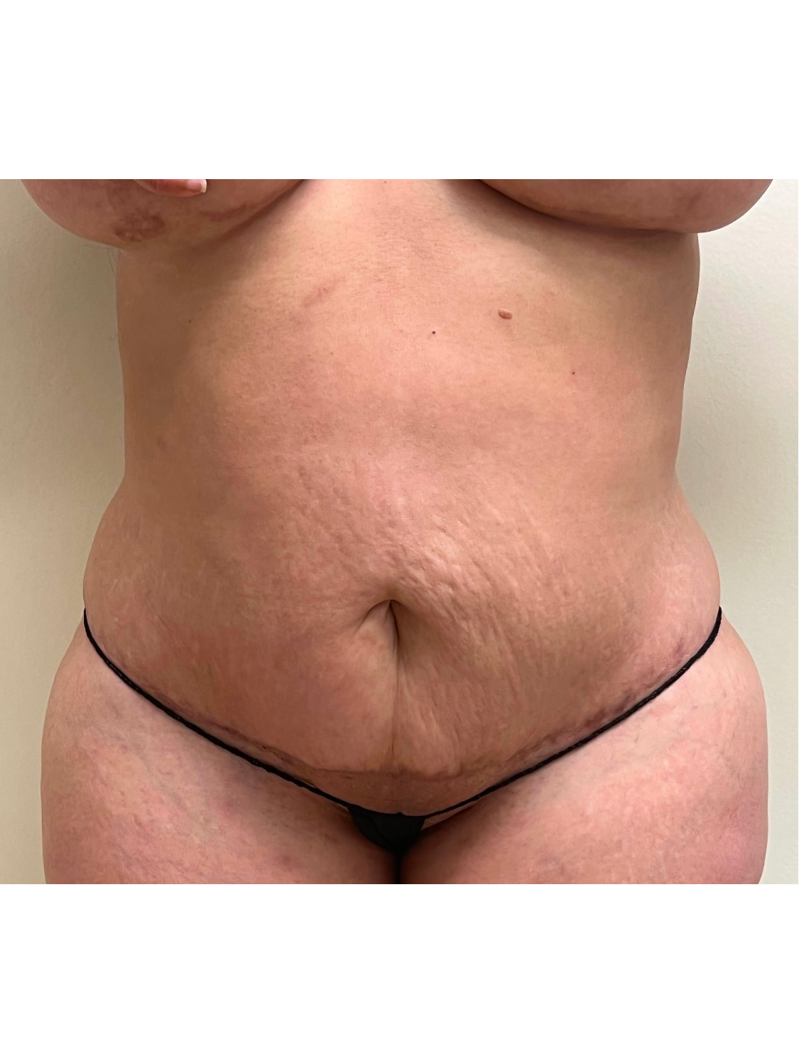 Tummy Tuck