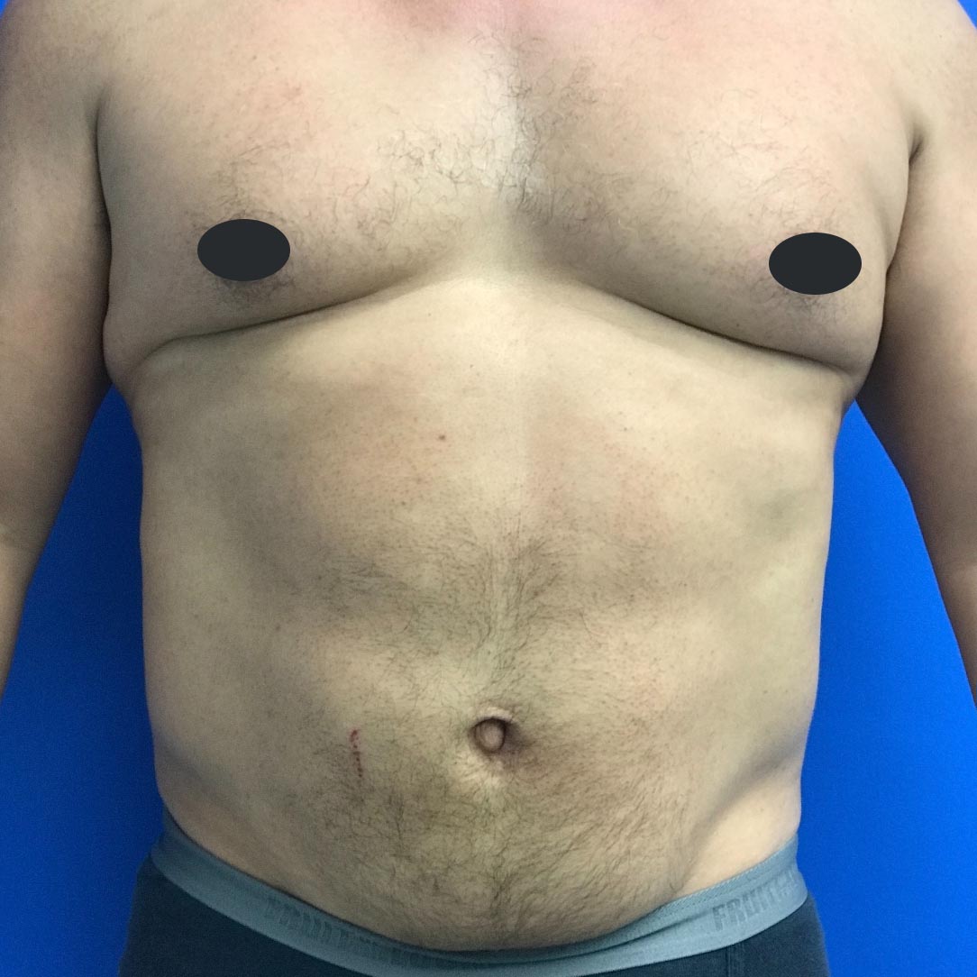 Gynecomastia