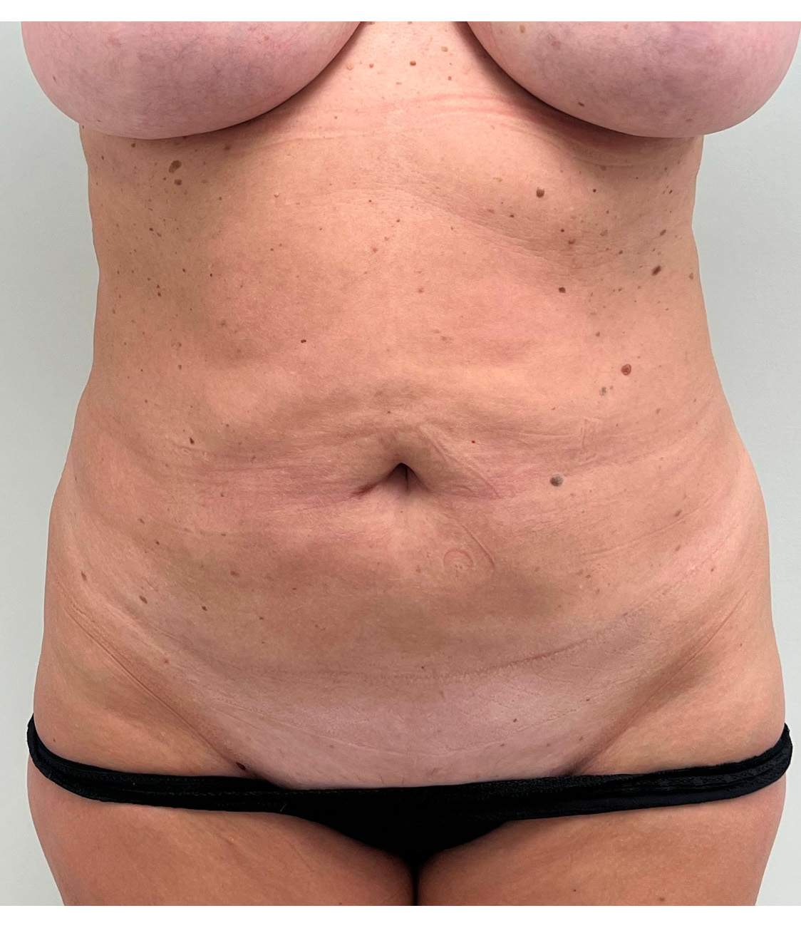Tummy Tuck