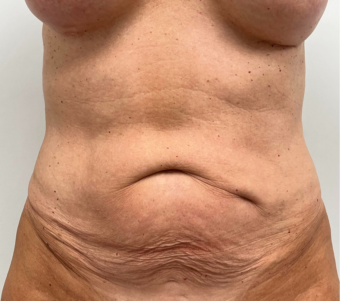 Tummy Tuck