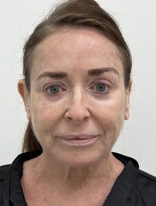 Le Spa Plastic Surgery Before and After Photos