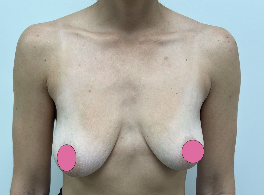 Breast Augmentation with Lift