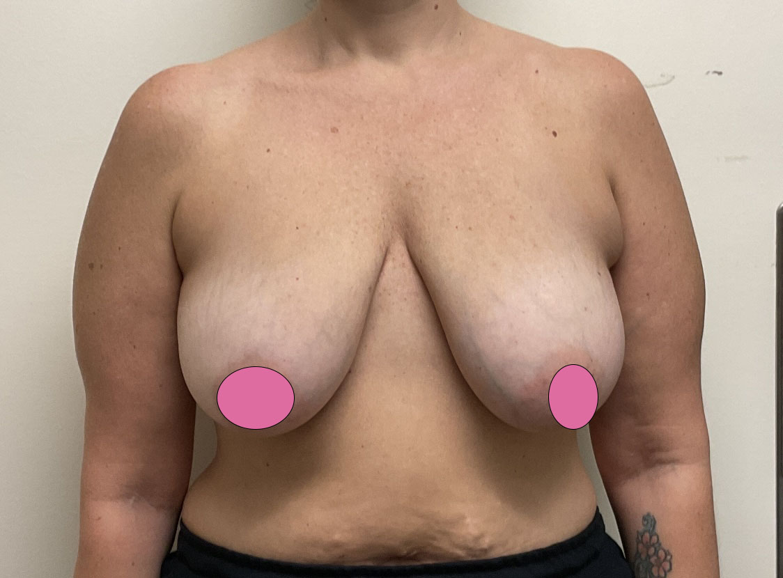 Breast Augmentation with Lift