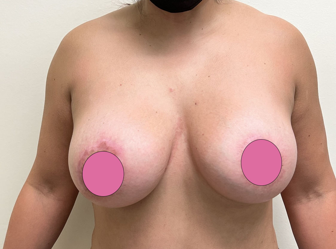 Breast Implant Revision