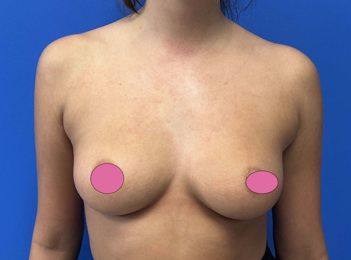 Breast Augmentation Before & After