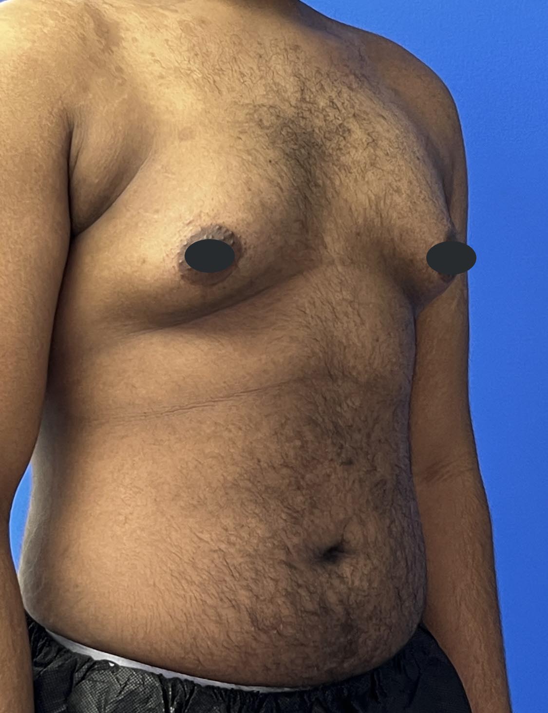 Gynecomastia