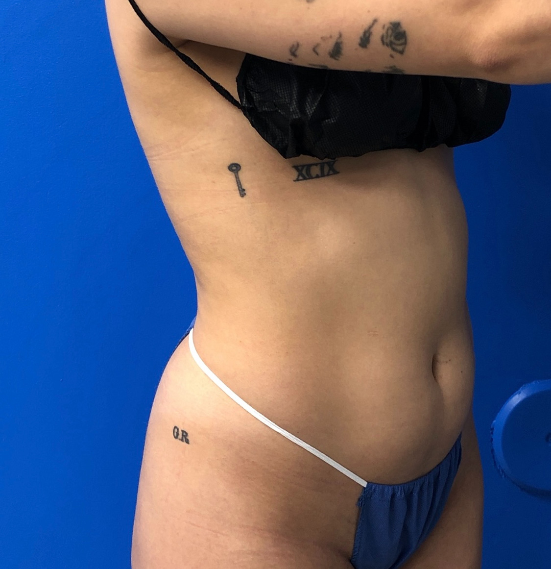 Brazilian Butt Lift Before & After