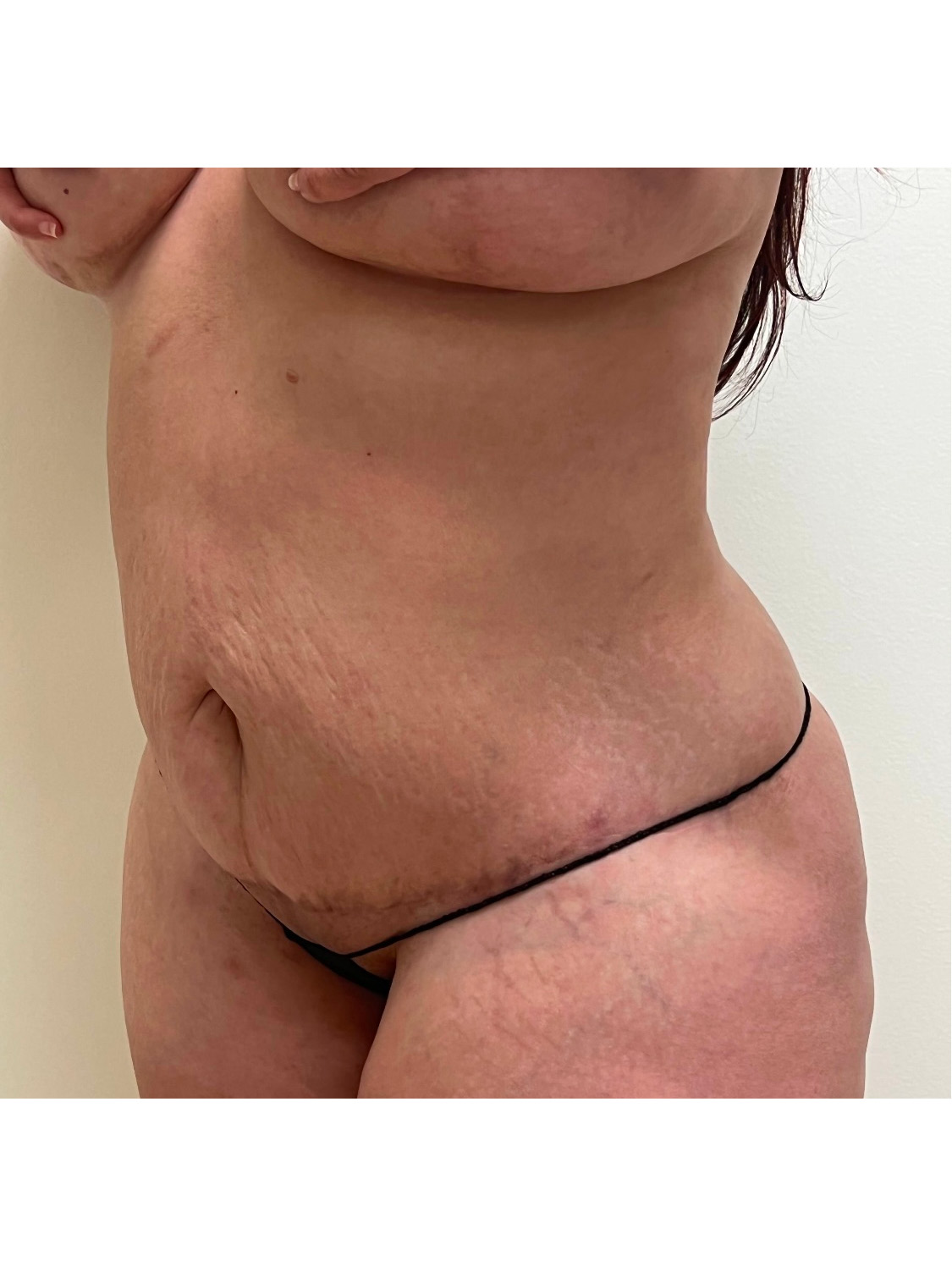 Tummy Tuck