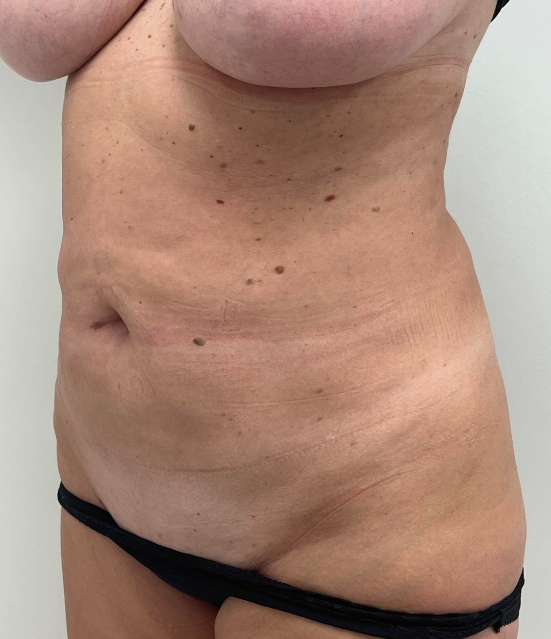 Tummy Tuck