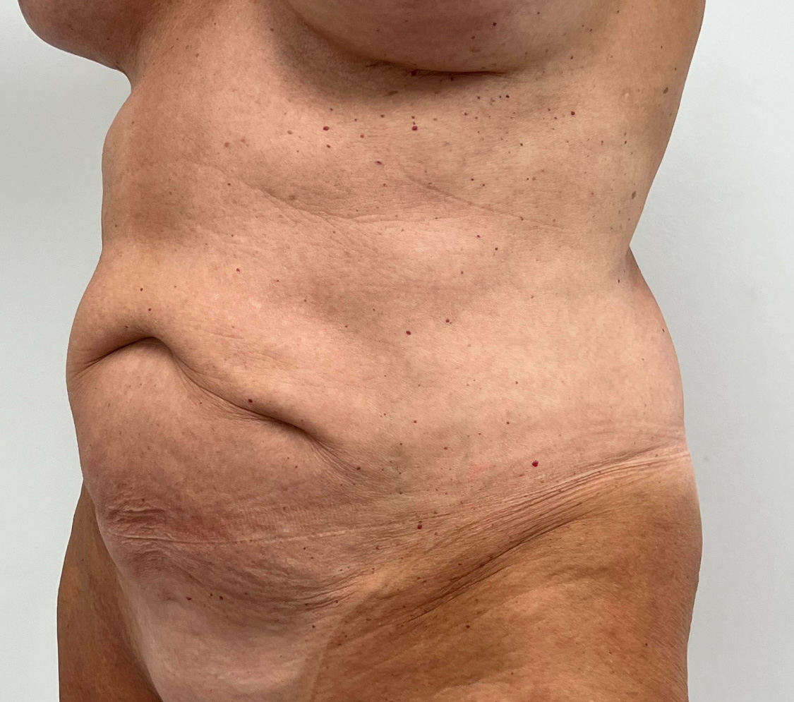 Tummy Tuck