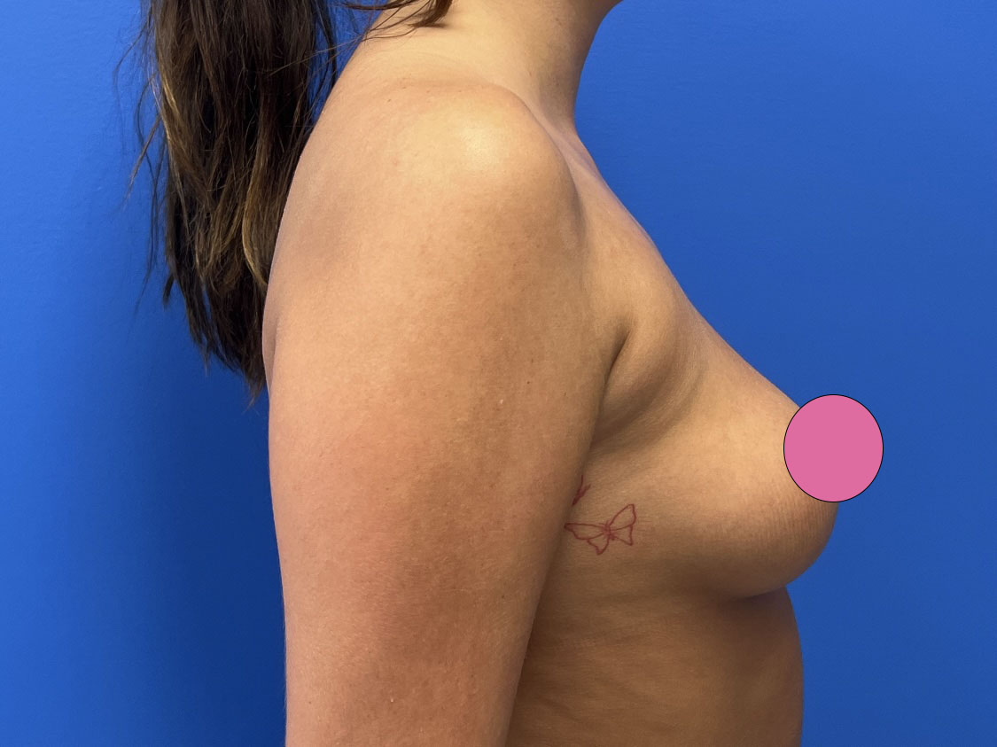 Breast Augmentation Before & After