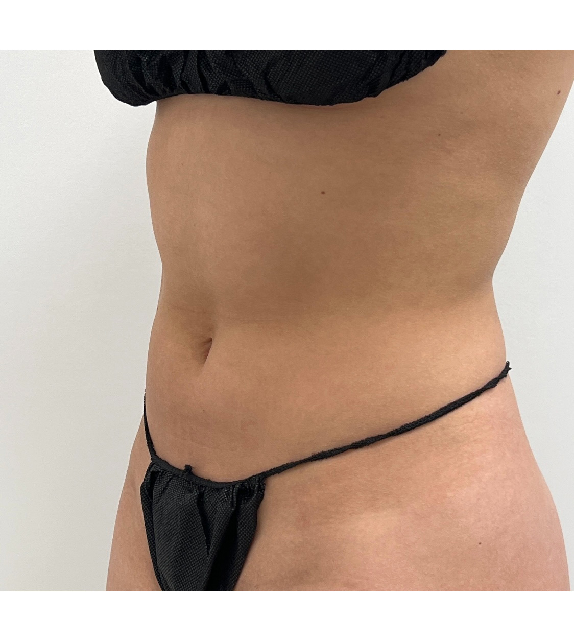 Liposuction