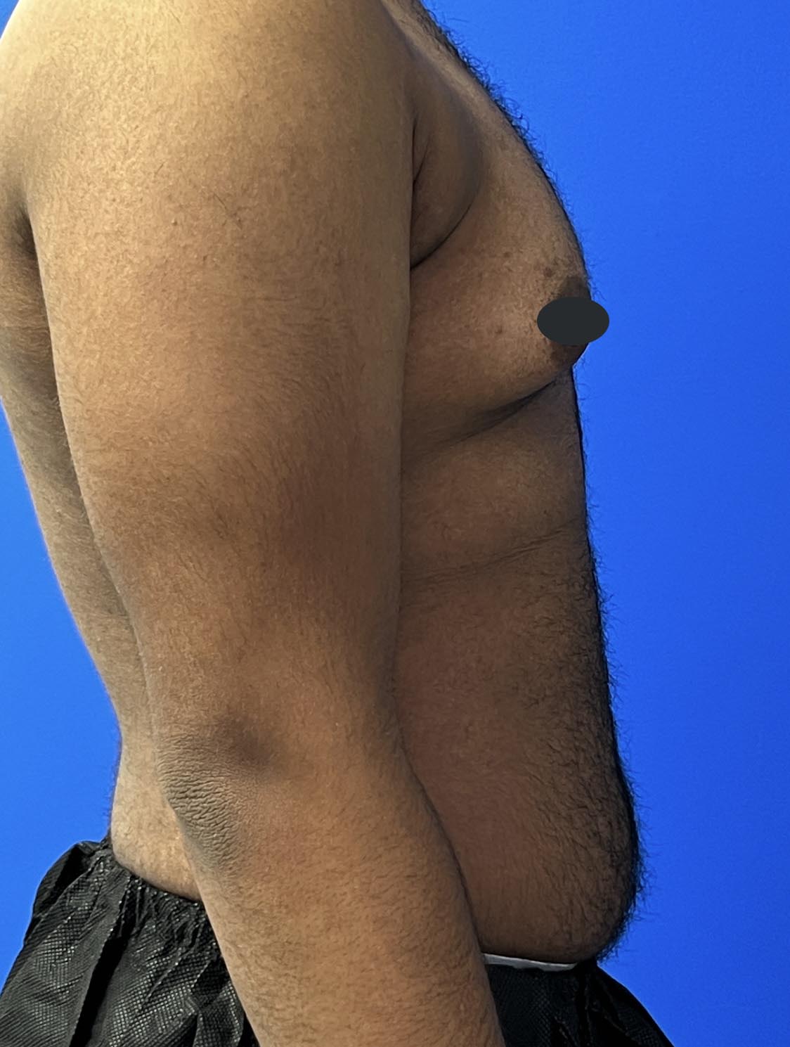 Gynecomastia